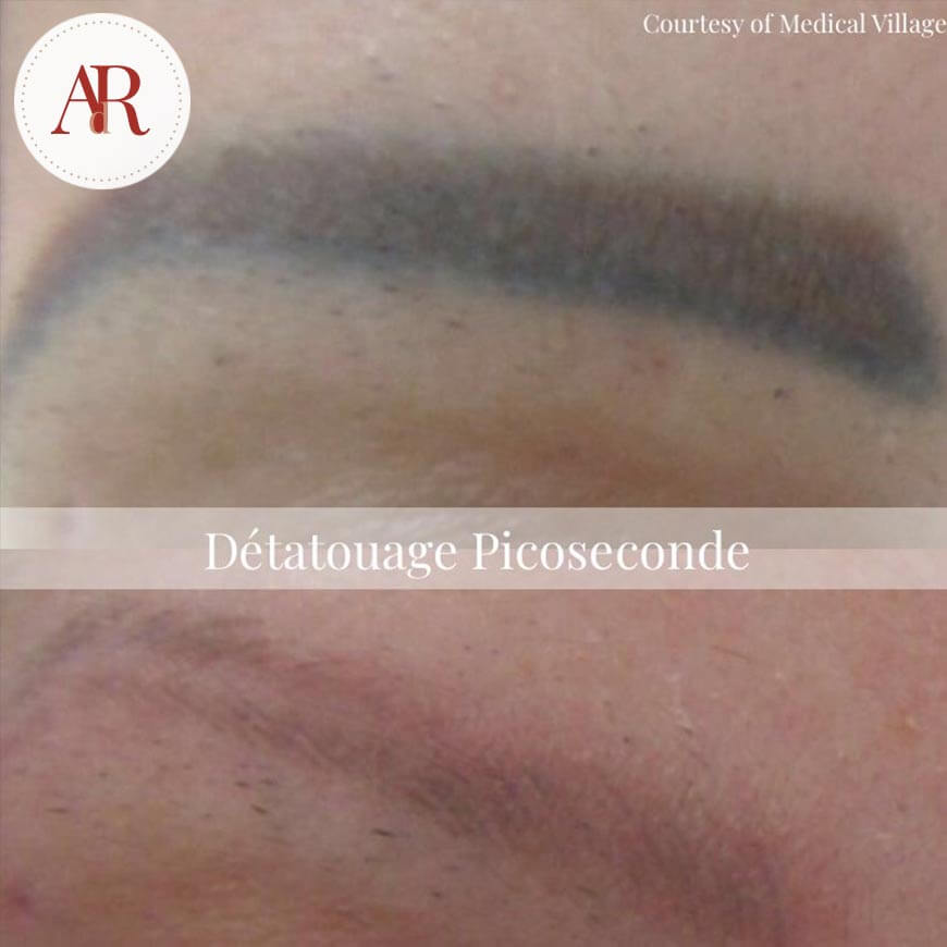 AVANT-APRES-detatouage